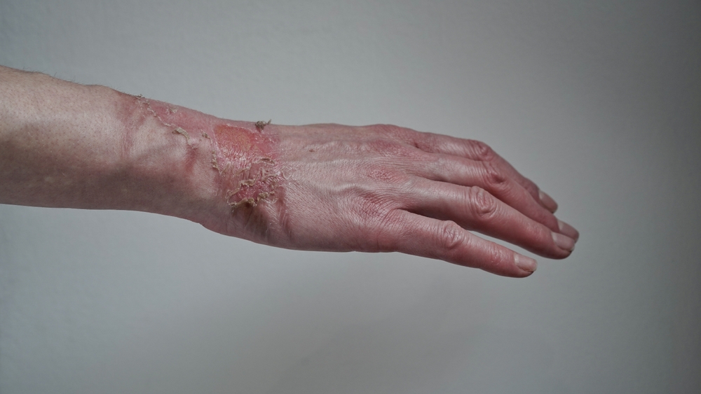 What to Do After a Fire or Burn Injury