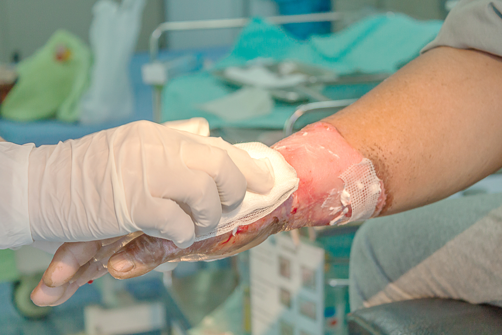 Where Fire and Burn Accidents Commonly Occur